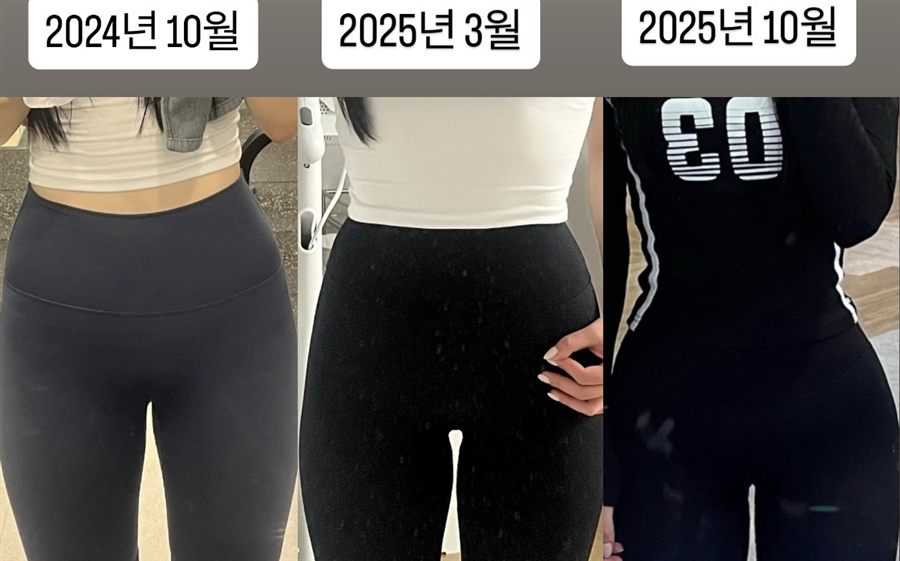 라인개선 힙 라인 변화 비교 1