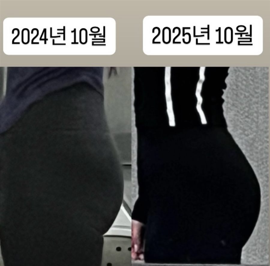 라인개선 힙 라인 변화 비교 2
