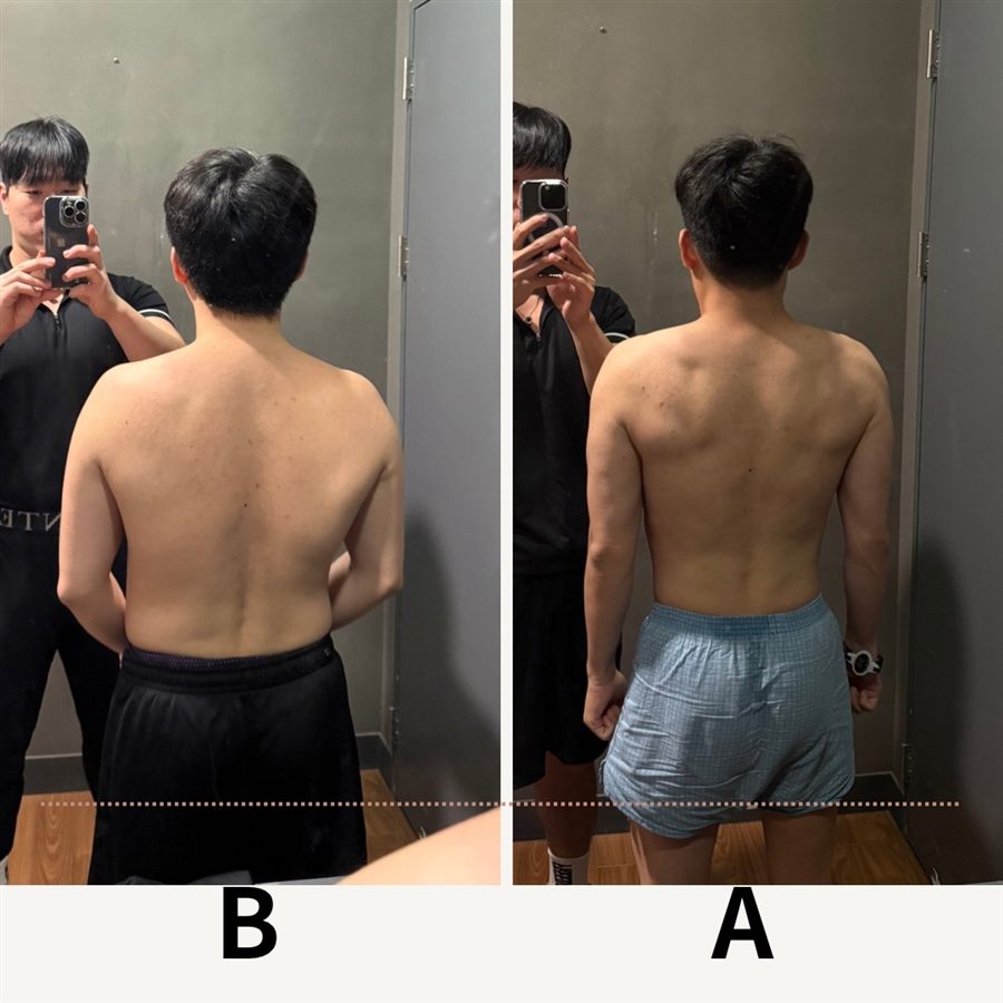 뒷모습 자세교정 변화 비교